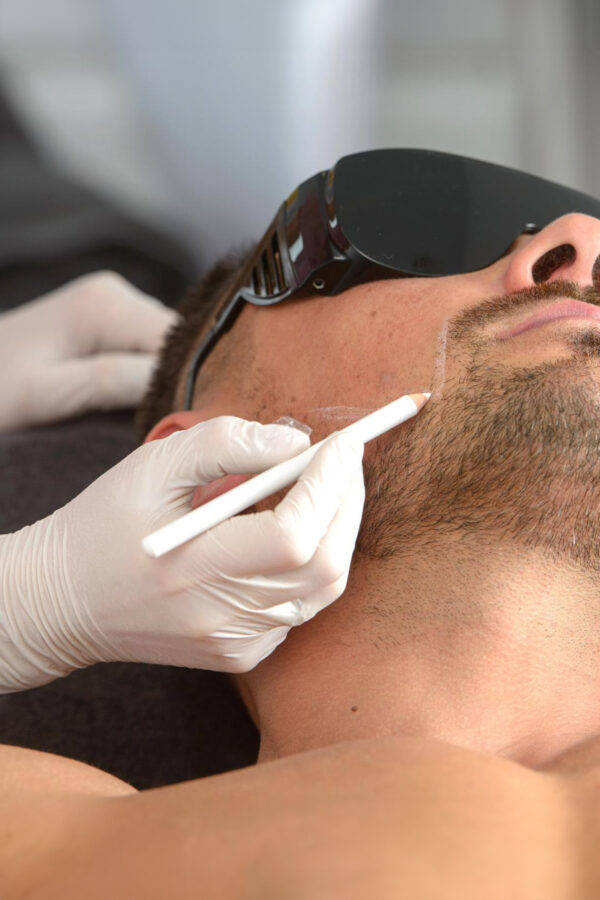 Depilación laser Él
